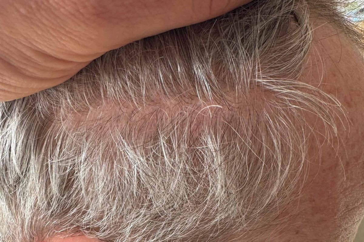 Dry Scalp: Why It Happens and What Helps